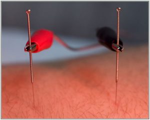 Acupuncture-Treatment-Cancer-5 - Beat Cancer Blog