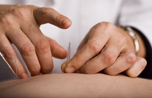 doctor performing acupuncture