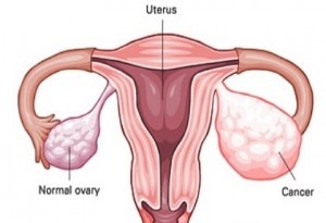 ovarian cancer diagram