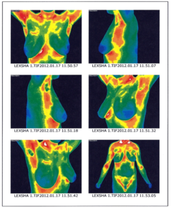 Thermogram-1-12-pg-6 Beat Cancer Blog
